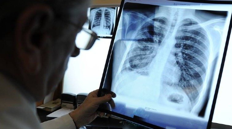 Литва и Латвия стали лидерами ЕС по смертности от туберкулеза - «Новости дня»