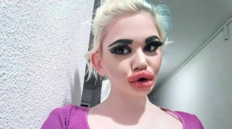 "Очень больно": обладательница самых огромных губ в мире пожаловалась на неудобства - «Культура»