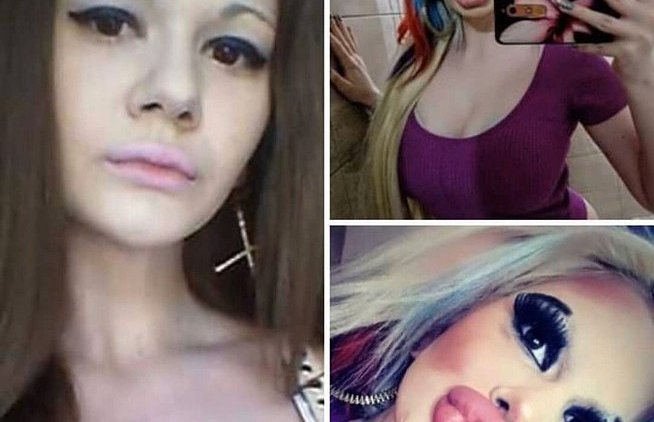 Она 20 раз увеличивала губы - «Новости дня»