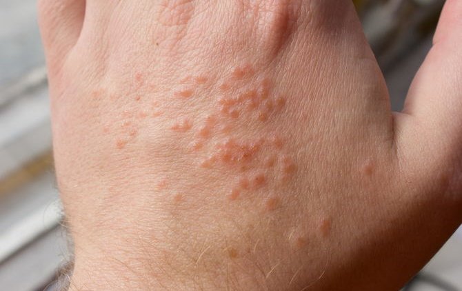 Высыпания на коже — новый cимптом коронавируса (COVID-19) - «Новости дня»