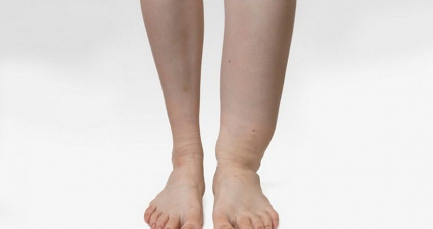 Эффект слоновой ноги: лечение лимфостаза и причины отекания конечностей