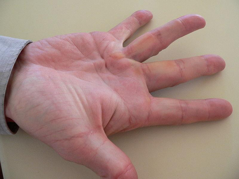 Ученые: «Болезнь викингов» имеет неандертальское происхождение
